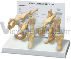 4-Stage Arthritic HipPharmaceutical and Anatomical Model Gifts